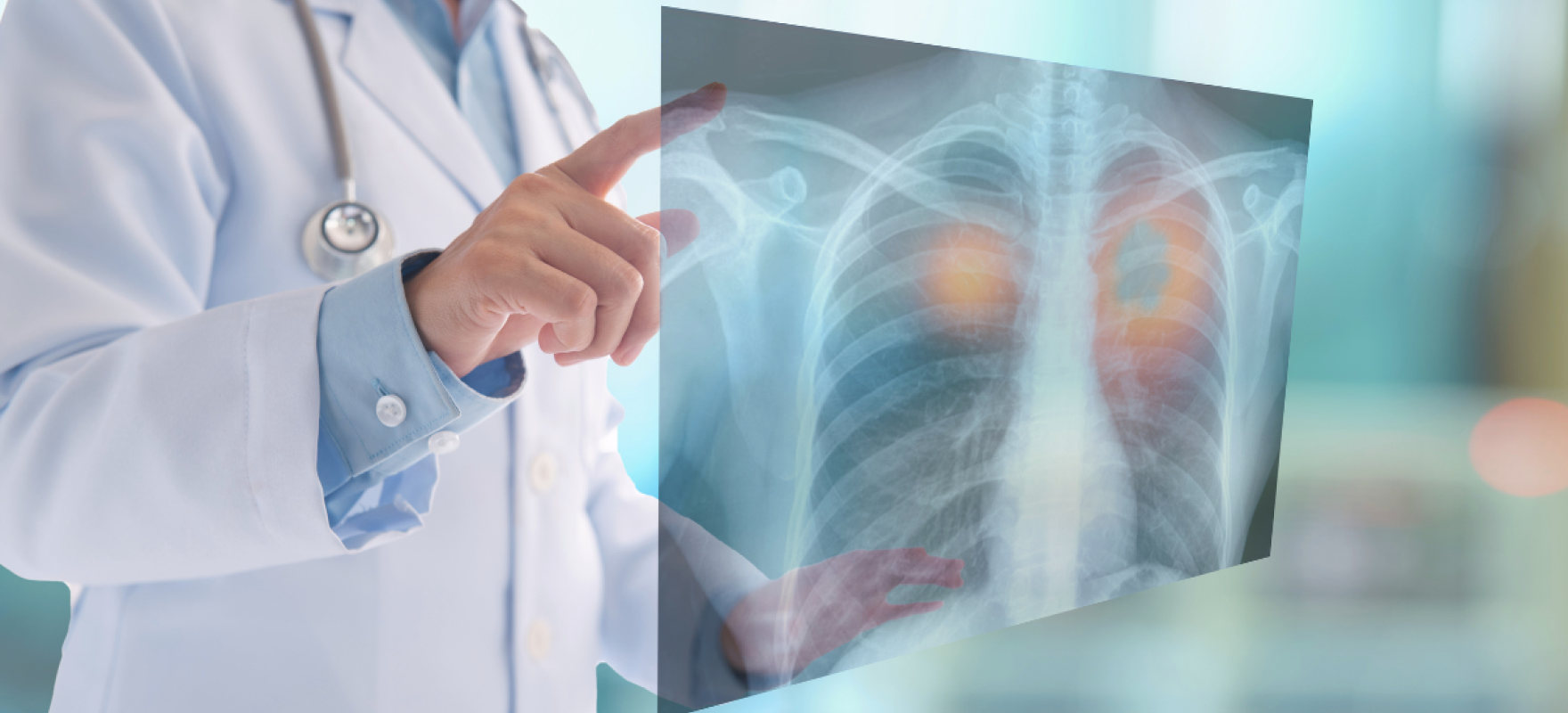 arst, kopsuröntgen, vähk